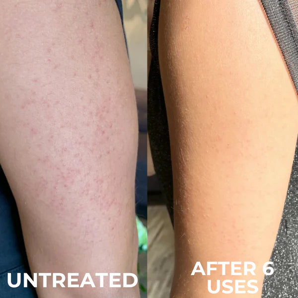 KeraMelt™ Gentle Triple-Acid Keratosis Pilaris Cream