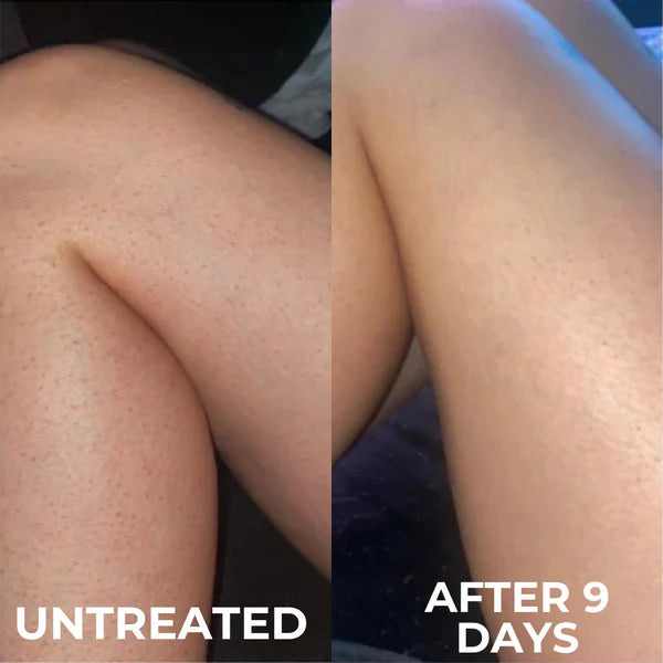 KeraMelt™ Gentle Triple-Acid Keratosis Pilaris Cream