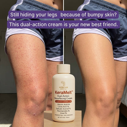 KeraMelt™ Gentle Triple-Acid Keratosis Pilaris Cream