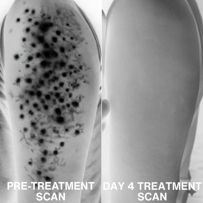 KeraMelt™ Gentle Triple-Acid Keratosis Pilaris Cream