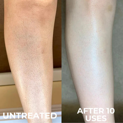 KeraMelt™ Gentle Triple-Acid Keratosis Pilaris Cream
